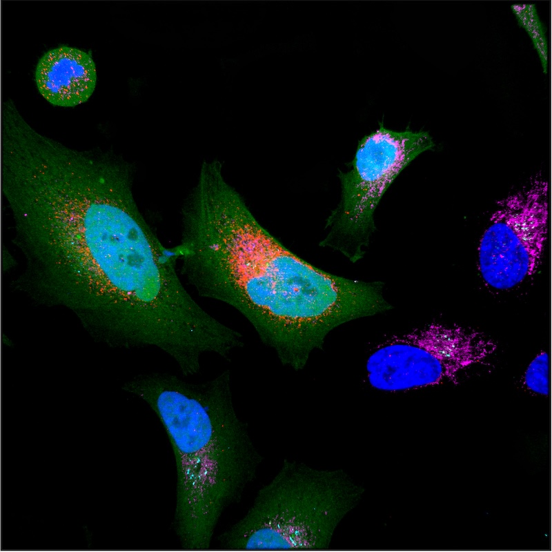 Célula cancerosa expresando microproteínas (en rojo)